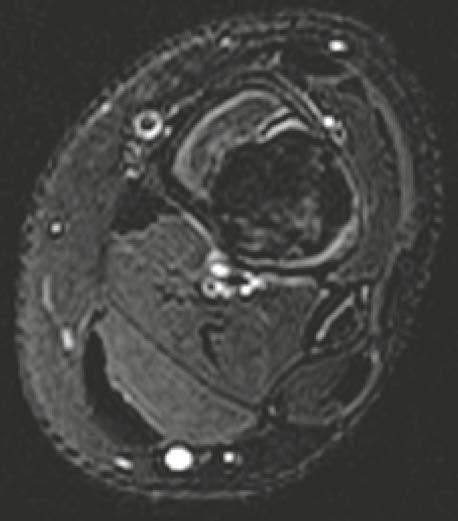 Key to diagnosis: A lytic lesion with expansive growth and scalloped, welldefined sclerotic border. The MRI appearance of an NOF is somewhat variable.