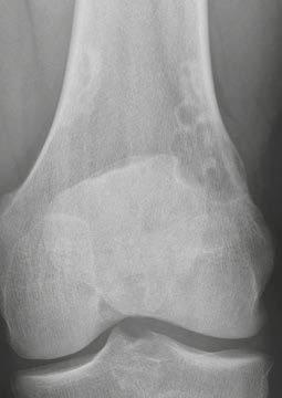 Clinical Orthopedic Imaging 20 A 20 B 20 C 20 D 20 E 20 Image gallery of the non-ossifying fibroma.