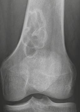 (20C) Antero-posterior radiograph of the knee of a 12-year-old male patient shows a lytic lesion with
