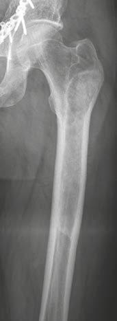 Orthopedic Imaging Clinical Fibrous dysplasia (Figs. 21 23) Patients have usually no pain or periosteal reaction.