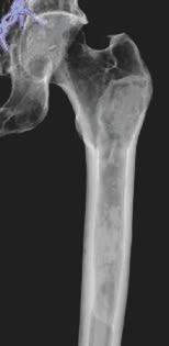 Fibrous dysplasia shows lytic lesions, as the matrix calcifies it has a hazy, smoky and ground-glass look to the point of sclerotic