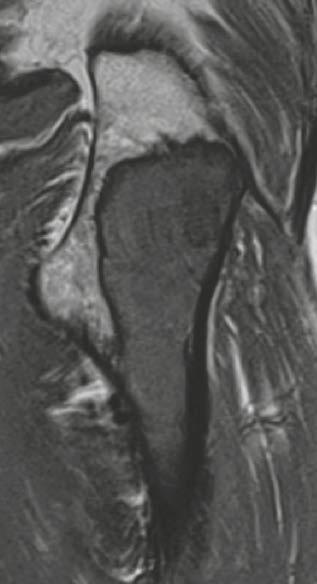 The signal alterations of fibrous dysplasia in MRI follow the uniform pattern of all tumors (low signal in T1-weighted and intermediate