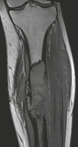 (22B) Antero-posterior radiograph of the right knee of a 33-year-old female patient shows a circumscripted
