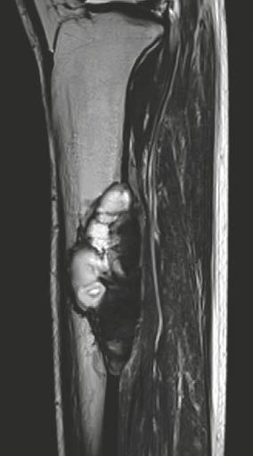 (22C) Lateral radiograph of the left lower leg of a 22-year-old male patient with a fibrous dysplasia of