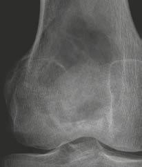 the classification of Lodwick [3]. In radiographs there is a correlation between bone tumor s growth rate and dignity.