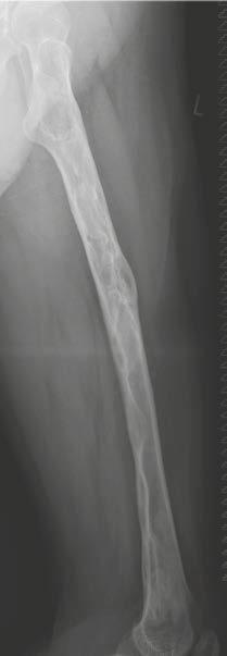 antero-posterior radiograph of the left femur and (23C) lateral