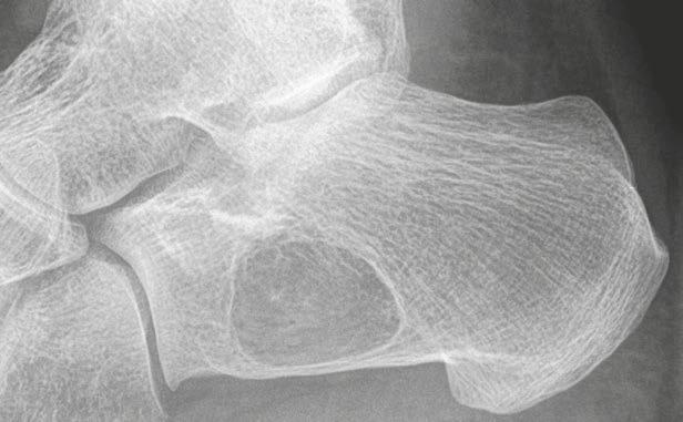 Orthopedic Imaging Clinical Other types Solitary bone cyst (Figs. 25, 26) Patients are usually younger than 20 years.