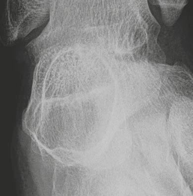 The fracture often produces fragments that sink to the bottom of the lesion, well known as the fallen fragment sign visible on radiographs.
