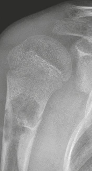 Clinical Orthopedic Imaging 26 A 26 B 26 Image gallery of solitary bone cyst with the fallen