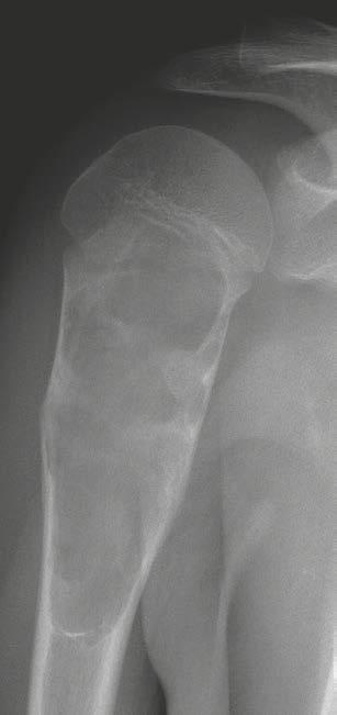 (26A) Antero-posterior radiograph of the right shoulder of a 9-year-old female patient with the