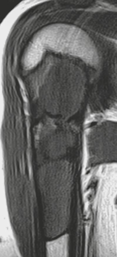 Figures 26B E show the case of an 11-year-old patient with a solitary bone cyst also in the right
