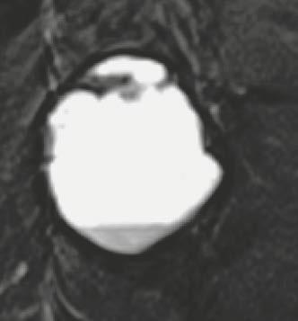 26 C 26 D (26C) Shows a coronal T1w MRI with low signal of the lesion and (26E) shows an axial T2w