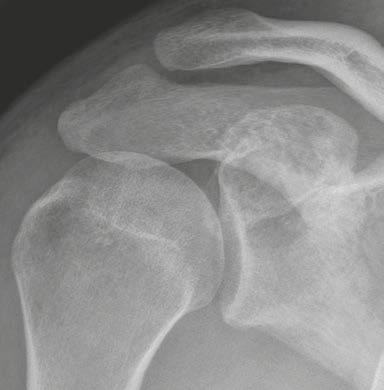 Orthopedic Imaging Clinical Aneurysmal bone cyst (ABC) (Fig. 27) The patients are usually younger than 20 years.