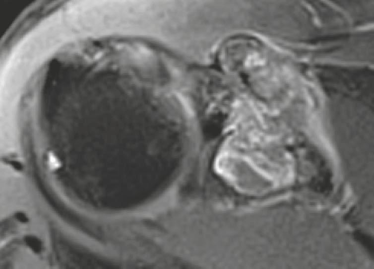 Sedimentation effects of blood-filled cysts with fluidfluid levels and contrast-enhancement of the cystic wall and the septa are typical signs in MRI.