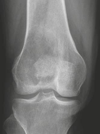 Clinical Orthopedic Imaging Giant cell tumor (Fig. 28) A precondition is that the epiphysis is closed.