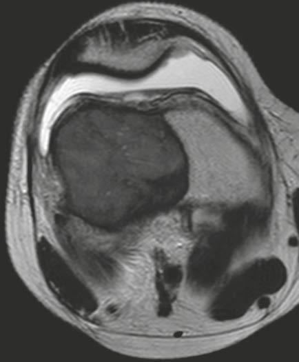 The tumor shows low signal in T1-weighting, inhomogeneous or low signal in T2-weighting and contrast-enhancement.