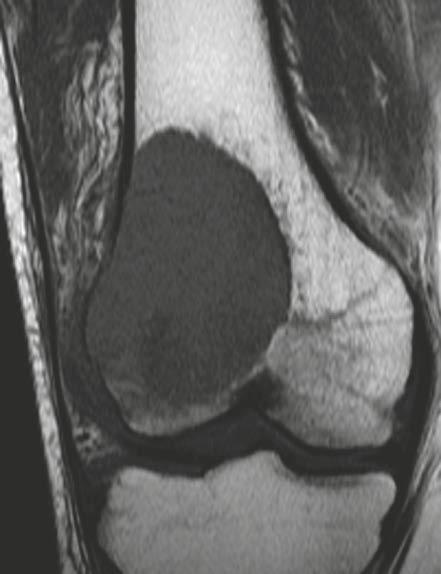 28 C 28 D 28 E 28 34-year-old female patient with giant cell tumor of the distal right femur.