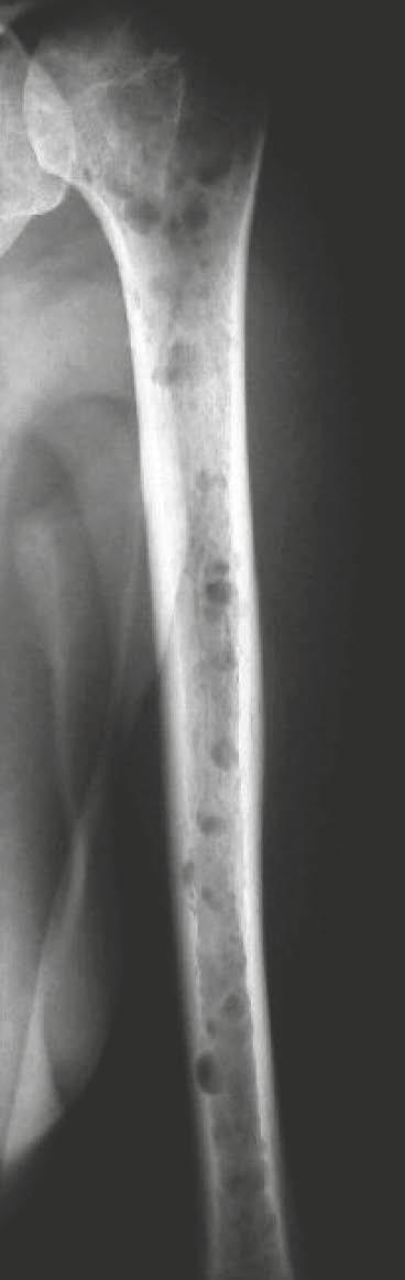 Clinical Orthopedic Imaging Multiple myeloma (Fig. 31) In multiple myeloma, a proliferation of monoclonal plasma cells within the bone marrow occurs.