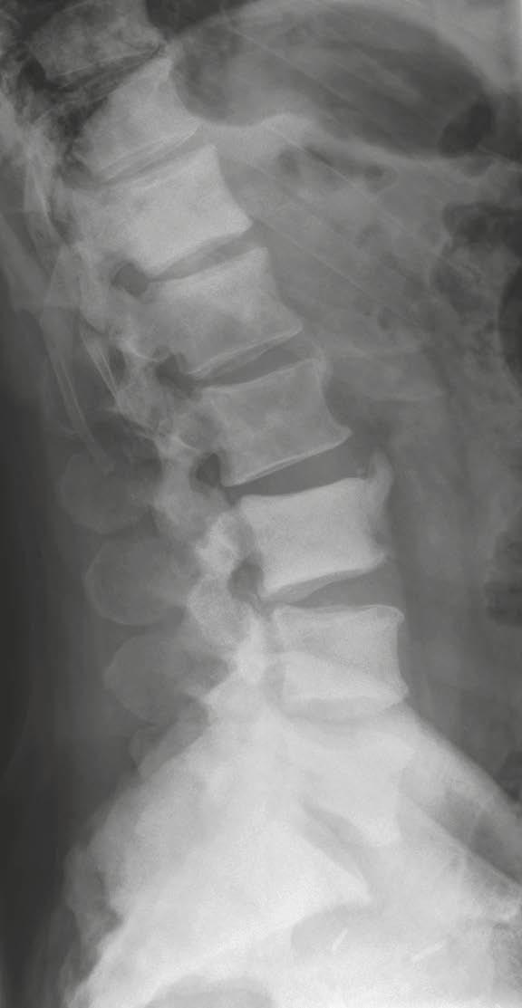Orthopedic Imaging Clinical Metastases (Fig. 32) 40% of all metastases are located in the vertebral column.