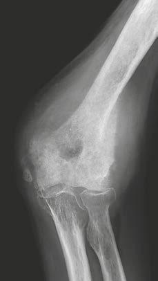 Figures 3A D show an example of an 80-year-old man with a cloudy inhomogeneous tumor of the distal humerus with perpendicular periosteal reaction of a malignant sunburst type, partial cortical