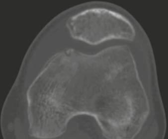Clinical Orthopedic Imaging 5A 5B 5C 5D 5E 5F 5 17-year-old male patient with articular osteoid osteoma (OO) of the left knee joint.