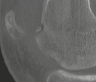 The axial T2w MRI with fat saturation (5D) demonstrates the joint effusion and synovitis (yellow arrow).