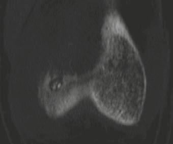(5E) Sagittal PDw MRI also shows the calcification. (5F) Axial contrast-enhanced T1w MRI with fat saturation demonstrates the enhancing nidus (orange circle).