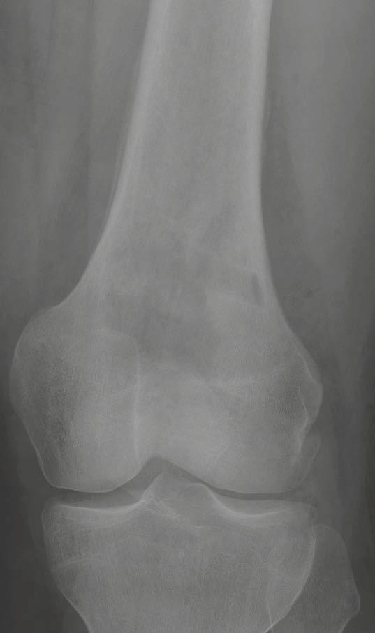 Figure (6A) shows the antero-posterior and (6B) the lateral radiograph.