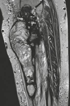Figures 8D (axial T2w MRI with fat saturation) and 8E (axial