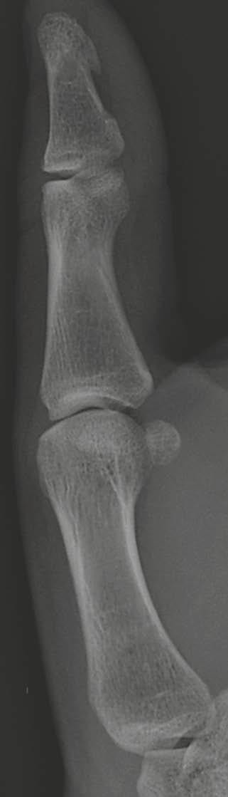 Orthopedic Imaging Clinical Chondroid type Enchondroma Enchondroma is a benign lytic lesion typically placed in the hand and chiefly centrally located, often with endosteal