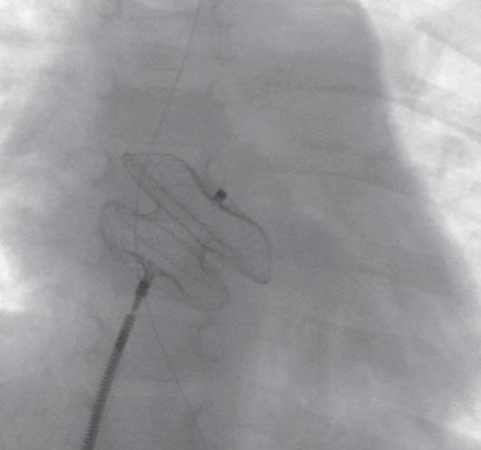 device through a sheath as small as the 6F or 7F. This technological advancement took place due to the use of Nitinol material for cardiac devices.