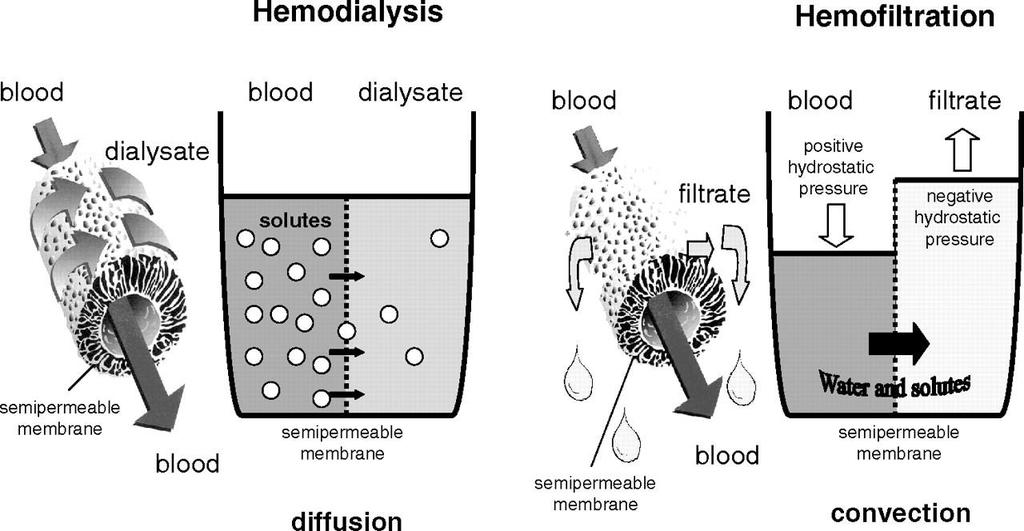 Ultrafiltration Removal of isotonic fluid from the venous compartment via filtration of plasma across a semipermeable membrane.