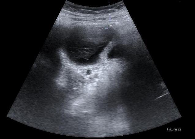 hematometra with stretched myometrium and small cervix.