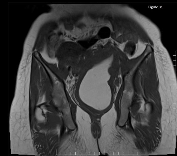 Figure 3a: MRI showing hematometra appearing