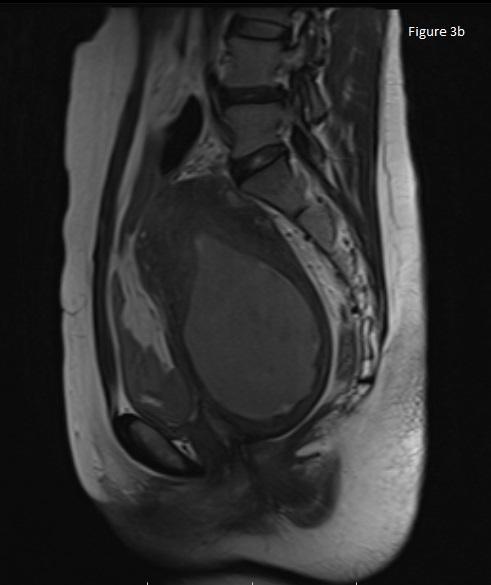 Figure 3b: MRI Sagittal T2WI showing