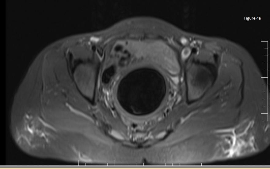 Figure 4a: MRI showing hematometra nullified
