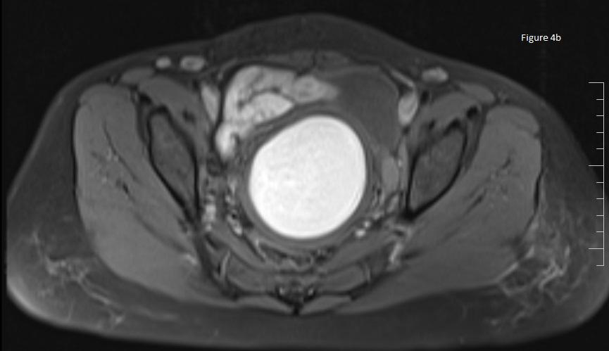Figure 4b: MRI showing hematometra appearing hyperintense on axial T1 FATSAT. Figure 5a: MRI showing bilateral dilated fallopian tubes due to blood appearing hyperintense on Axial T1WI.