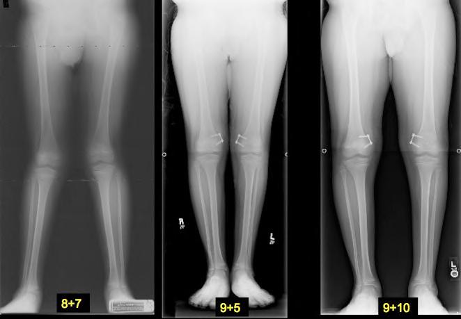 Correction of an 8 year old with genu valgum (knock knees) and patella instability corrected with a growth modulating implant to straighten the legs improving patella stability Please contact our