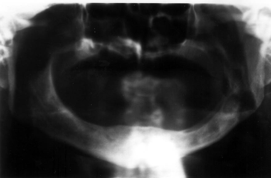 Slika 4. Kontrolna rtg-snimka, otprilike 11 mjeseci nakon operacije, pokazuje iznenađujuće dobar nalaz novostvorene kosti u području ranijeg defekta Figure 4.