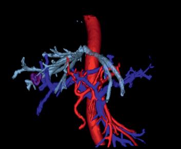 The 3D image demonstrates the spatial arrangement of the hepatic artery, the portal vein and hepatic veins showing the anatomical relationship of the hepatic nodule with the vascular liver structures.