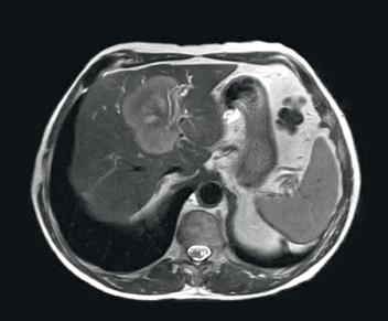 User experiences T1 mdixon arterial phase T1W mdixon portal phase DWI MIP bile ducts VRT bile ducts and portal vein Large centro-hepatic cholangiocarcinoma A 54-year-old male is
