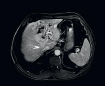 DWI demonstrates restriction predominantly at the peripheral part of the mass. No evidence of adjacent lesions into the liver.
