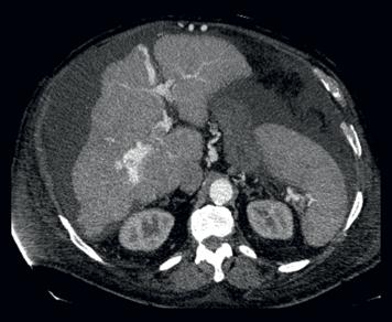 CT DWI T1W mdixon pre contrast T1W arterial phase T1W portal phase Multifocal liver hepatocellular carcinoma A 57-year-old male with decompensated cirrhosis is referred to MRI to visualize the