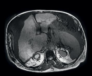 The left portal branch is the site of a suspended thrombus. T2-weighted MRI demonstrates large effusion ascites, heterogeneous liver with the presence of multiple slightly hyperintense nodules.