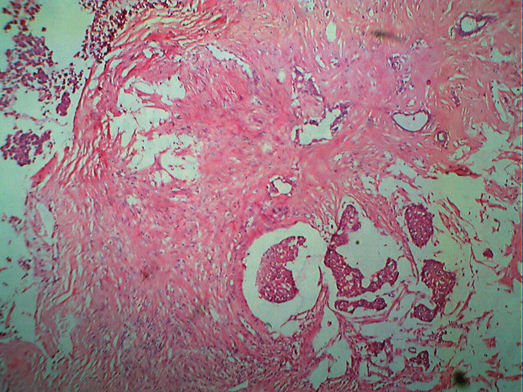 Cystic papillary tumour with soild area of