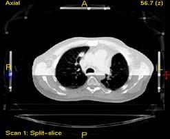 breathing Frame registration helps to contrast the tumor