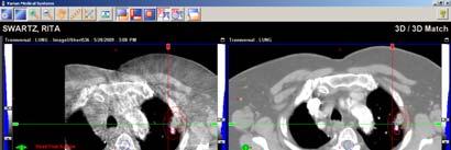 Cone Beam CT Guidance after soft tissue alignment Image Guidance using CT-on-Rails PRIMART Siemens PRIMARTOM