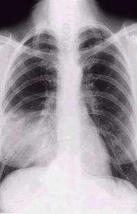 Pulmonary Cases 60-year old previously healthy