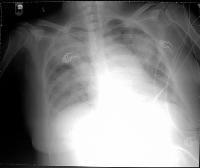 Pulmonary-3 An SICU patient needs prolonged intubation