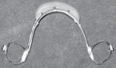 is up to the incisive papilla.the second wire is adapted in such a way that it comes in contact with the first base wire posteriorly in 2 nd premolar region (Fig ).